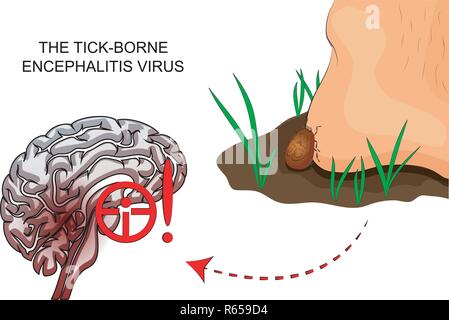 Illustration d'une encéphalite tiques et l'inflammation du cerveau Illustration de Vecteur