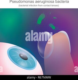 Les infections bactériennes à partir de lentilles de contact, est résistant aux antibiotiques. Illustration de Vecteur