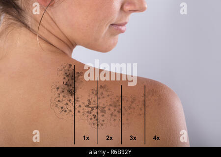 Détatouage au laser sur l'épaule de Femme Banque D'Images