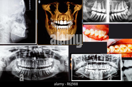 Et panoramique dentaire 3D x-ray de coups Banque D'Images