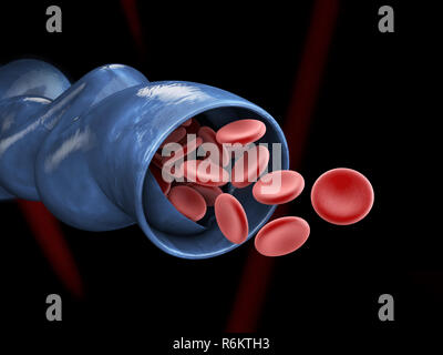 Varices close up. Les jambes sur un fond noir, 3d illustration. Banque D'Images