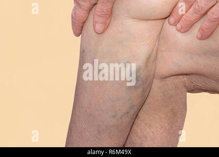 Les varices sur les jambes d'une vieille femme sur bleu Banque D'Images