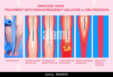 Varices et le traitement par ablation par radiofréquence Banque D'Images
