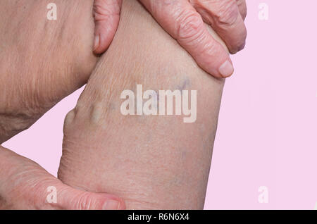 Les varices sur les jambes d'une vieille femme sur des tons pastel Banque D'Images