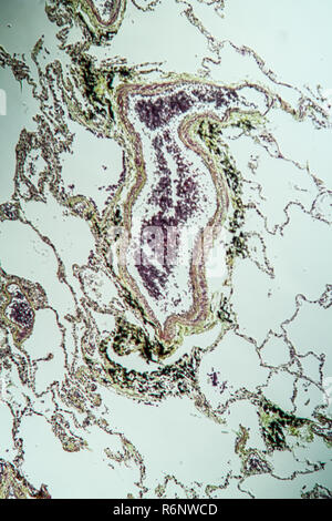 Avec l'asthme pulmonaire sous microscope d3m Banque D'Images