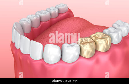 La santé des dents et couronnes en or, dent précise médicalement 3D illustration Banque D'Images