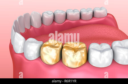 La santé des dents et couronnes en or, dent précise médicalement 3D illustration Banque D'Images