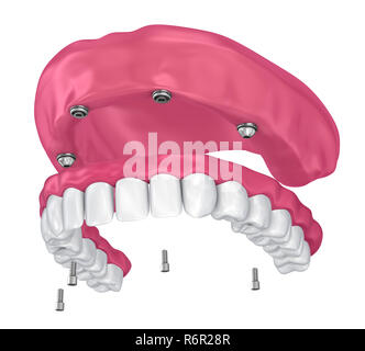 Pour Prothèse hybride être assis sur implants pièces jointes. 3D illustration Banque D'Images