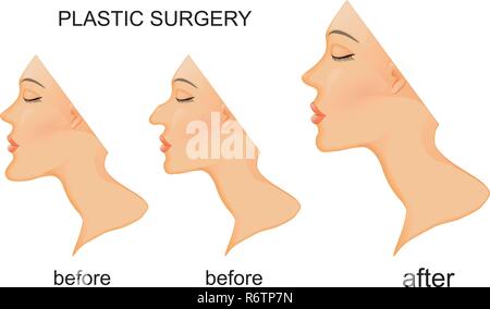 Illustration de la chirurgie plastique. le nez, le menton. avant et après. Illustration de Vecteur