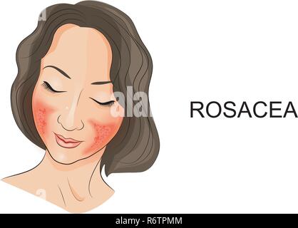 Illustration de la rosacée sur le visage de la fille. Dermatologie Illustration de Vecteur