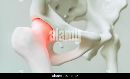 La douleur de hanche d'arthrose - 3D Rendering Banque D'Images