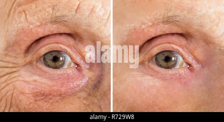 Close-up of a Senior Woman's Eye avec et sans rides après le traitement esthétique Banque D'Images