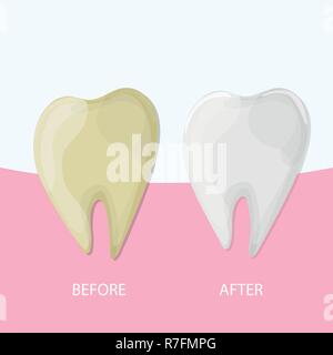 Blanchiment des dents professionnel, en bonne santé et des dents jaunes, vector illustration Illustration de Vecteur