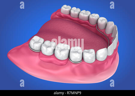 La prothèse partielle amovible. Illustration 3D précis médicalement Banque D'Images