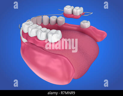 La prothèse partielle amovible. Illustration 3D précis médicalement Banque D'Images