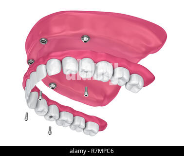 Pour Prothèse hybride être assis sur implants pièces jointes. 3D illustration Banque D'Images