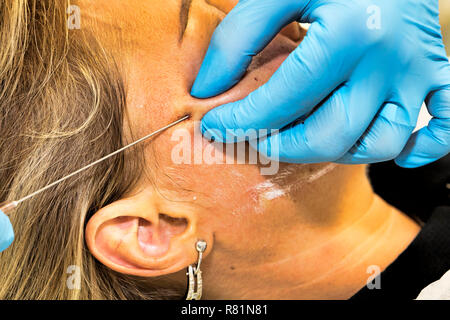 Le dermatologue effectue la procédure anti-âge en utilisant PDO thread sur middle-aged woman patient - selective focus Banque D'Images