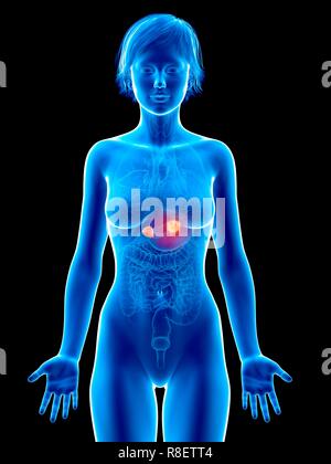 Illustration de cancer de la glande surrénale. Banque D'Images