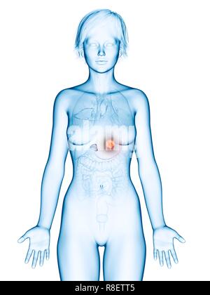 Illustration de cancer de la glande surrénale. Banque D'Images