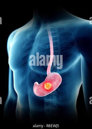 Illustration d'une tumeur à l'estomac de l'homme. Banque D'Images