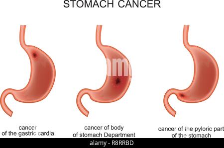 Vector illustration d'une des maladies cancéreuses de l'estomac Illustration de Vecteur