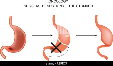 Vector illustration d'une gastrectomie Sous-total pour le cancer de l'estomac. Illustration de Vecteur