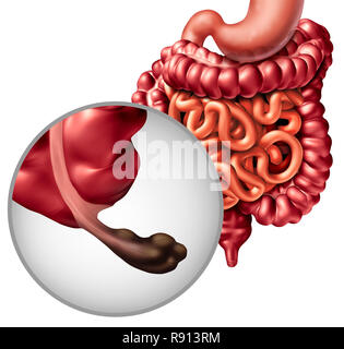 Le cancer et la maladie de l'annexe de l'intestin ou gastrointestnal la digestion avec une tumeur maligne symptômes et diagnostic problème que la digestion de l'inconfort. Banque D'Images