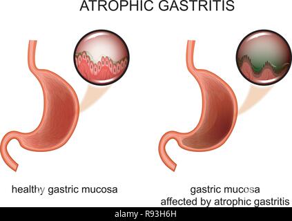 Illustration vecteur de gastrite atrophique. inflammation de la muqueuse. Illustration de Vecteur