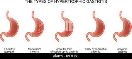 Vector illustration de la gastrite hypertrophique types Illustration de Vecteur