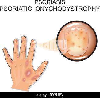 Vector illustration d'un rhumatisme psoriasique Psoriasis. onychodystrophy. Illustration de Vecteur