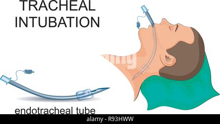 Vector illustration de l'intubation trachéale. La ventilation artificielle des poumons Illustration de Vecteur