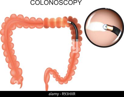 Vector illustration du gros intestin, colonoscop la médecine. Illustration de Vecteur