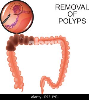 Vector illustration de polypes dans le côlon. dépose des polypes Illustration de Vecteur