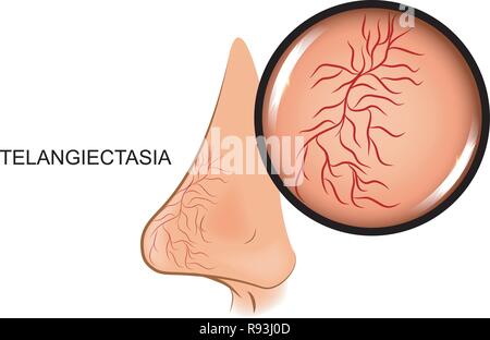 Vector illustration de dilatation des vaisseaux sanguins sur le nez. teleangiectasia, Illustration de Vecteur