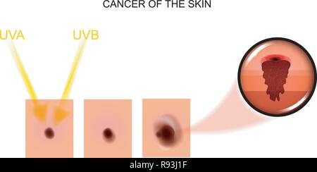 Vector illustration d'un cancer de la peau. De l'oncologie, la chirurgie Illustration de Vecteur