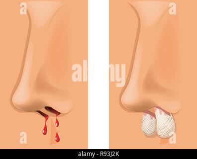 Vector illustration de tamponnade, les saignements du nez. Illustration de Vecteur