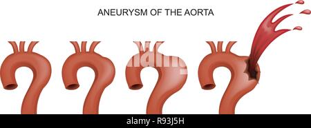 Vector illustration d'un anévrisme aortique en cardiologie. Illustration de Vecteur