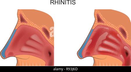 Vector illustration d'inflammation de la muqueuse nasale, rhinite. Illustration de Vecteur