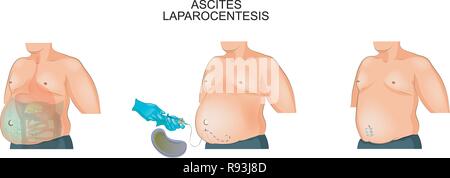 Vector illustration d'un homme souffrant d'ascite. Laparocentesis Illustration de Vecteur