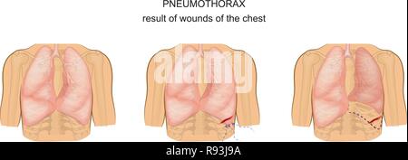 Vector illustration d'un pneumothorax par suite de blessures de la poitrine Illustration de Vecteur