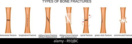 Vector illustration des types de fractures des os Illustration de Vecteur