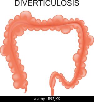 Vector illustration de la diverticulose du côlon Illustration de Vecteur