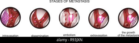 Vector illustration de l'étape de la métastase des cellules cancéreuses Illustration de Vecteur