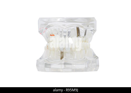 Implant dentaire dans la gencive. Isolé sur blanc. Banque D'Images