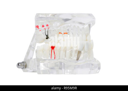 Implant dentaire dans la gencive. Isolé sur blanc. Banque D'Images