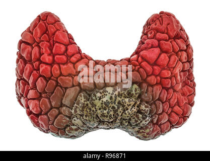 Concept de la maladie thyroïdienne, rendu 3D isolé sur fond blanc Banque D'Images