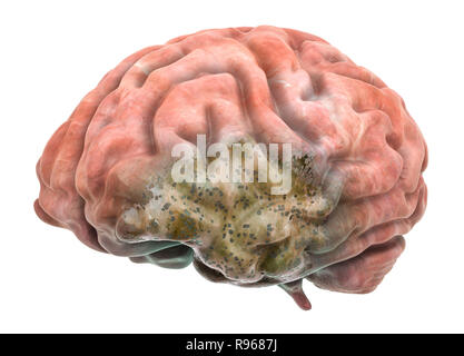 Maladies du cerveau concept. Le rendu 3D isolé sur fond blanc Banque D'Images