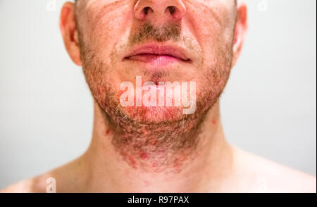 L'homme avec la dermatite séborrhéique dans la région de beard Banque D'Images