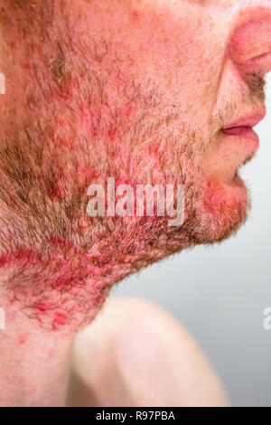 L'homme avec la dermatite séborrhéique dans la région de beard Banque D'Images