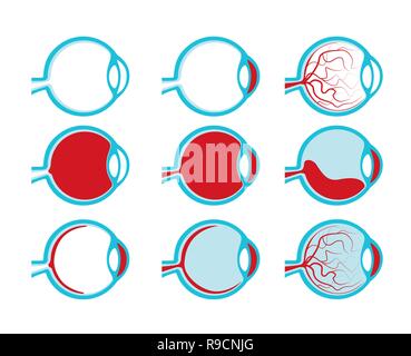 Des yeux humains sains et malsains sur la vue du côté de la section transversale de la santé médicale, iris Illustration de Vecteur